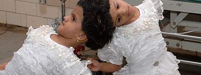 Vani y Veena, las siamesas indias de cuatro años Vani y Veena, las siamesas indias de cuatro años