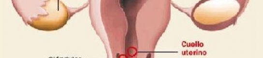 El cáncer de cuello de útero