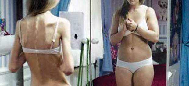 Anorexia y bulimia Anorexia y bulimia