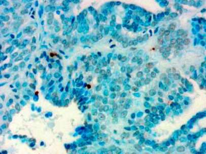 Tumor