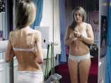 Anorexia y bulimia Anorexia y bulimia