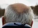 Alopecia Alopecia