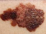 Melanoma Melanoma