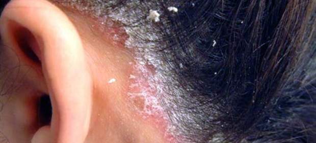 Si pasará atopichesky la dermatitis sobre la persona