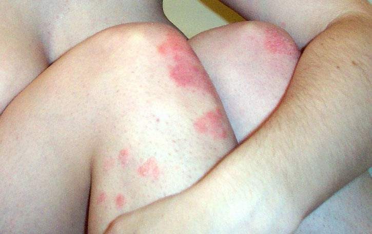 El champú de la psoriasis de la cabeza el precio