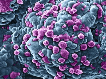 Breast cancer cells treated with nano sized drug carriers