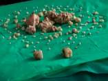 Extraen 232 piezas dentales a un joven Extraen 232 piezas dentales a un joven