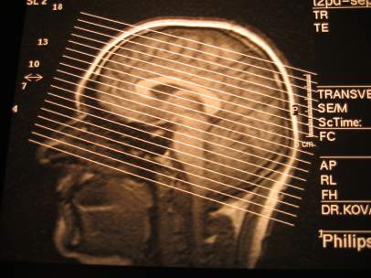 Cerebro