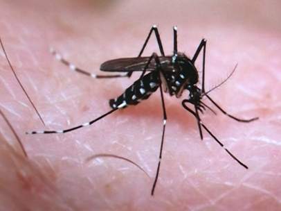 Primer caso de microcefalia por zika en España