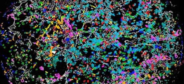 Imagen de recurso de un tumor