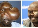 Operación de un tumor gigante en la cara Operación de un tumor gigante en la cara