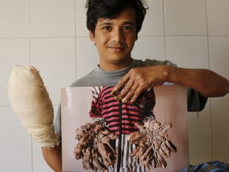 El 'hombre árbol' recupera sus manos