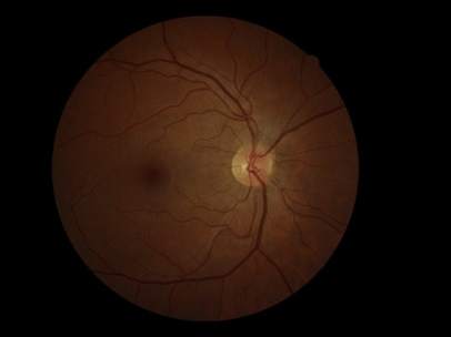 Glaucoma