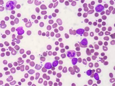 Leucemia linfática crónica (LLC)