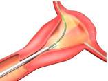 Essure Essure