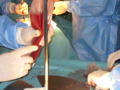 Técnica de extracción de médula ósea en quirófano
