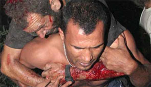 Heridos por el bombardeo israelí Heridos por el bombardeo israelí