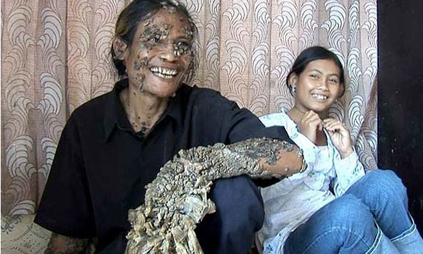 Detalle de Dede, el pescador indonesio conocido como "hombre árbol". Detalle de Dede, el pescador indonesio conocido como "hombre árbol".