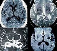 Ictus Ictus