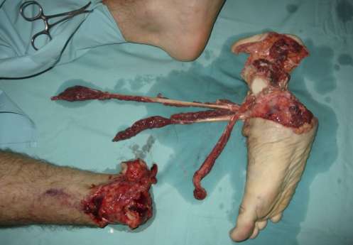 El doctor Cavadas ha reimplantado el pie amputado de un motorista El doctor Cavadas ha reimplantado el pie amputado de un motorista