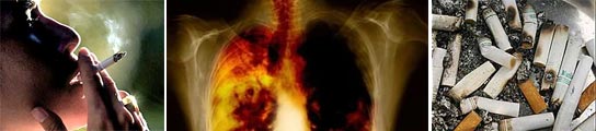 Cáncer de pulmón Cáncer de pulmón