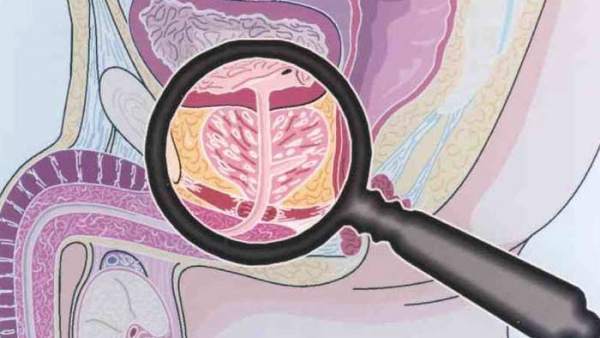Cáncer de próstata Cáncer de próstata