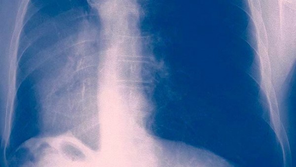 Cáncer de pulmón Cáncer de pulmón