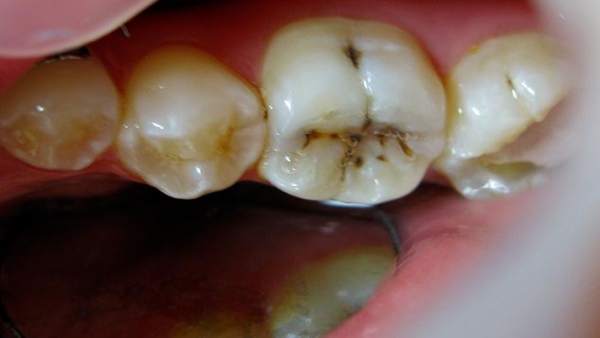 Caries Caries