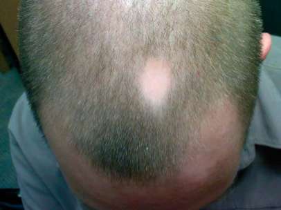 Alopecia