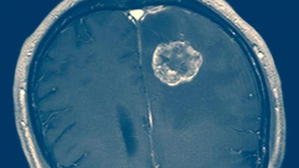Tumor cerebral Tumor cerebral