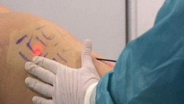Tratamiento para la celulitis Tratamiento para la celulitis