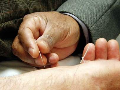 Acupuntura