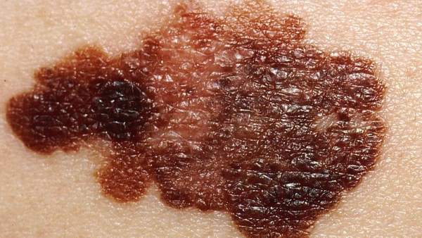 Melanoma Melanoma