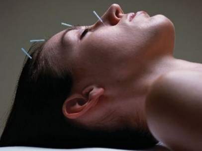 Acupuntura
