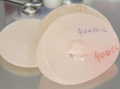 El problema de los implantes mamarios PIP