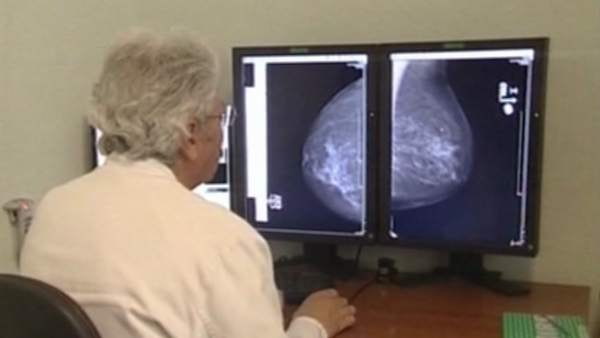 Cáncer de mama Cáncer de mama