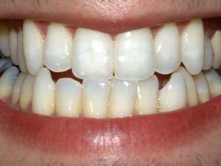 Dentadura