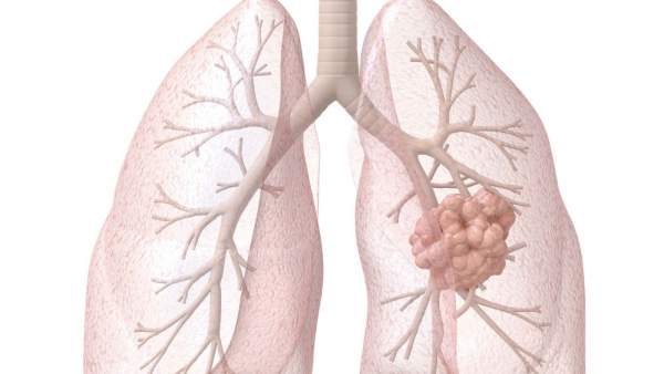 Cáncer Cáncer
