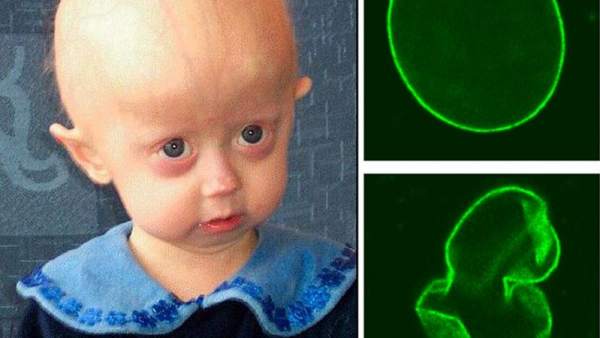 Progeria Progeria