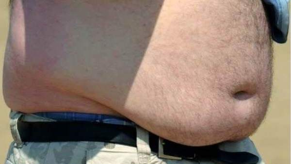 Obesidad Obesidad