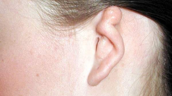 Microtia Microtia