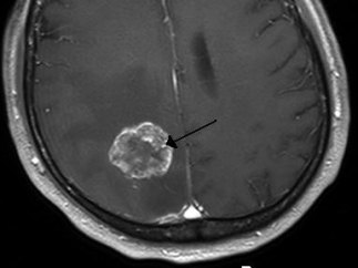 Metástasis en el cerebro
