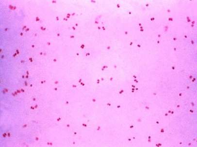 Gonorrea