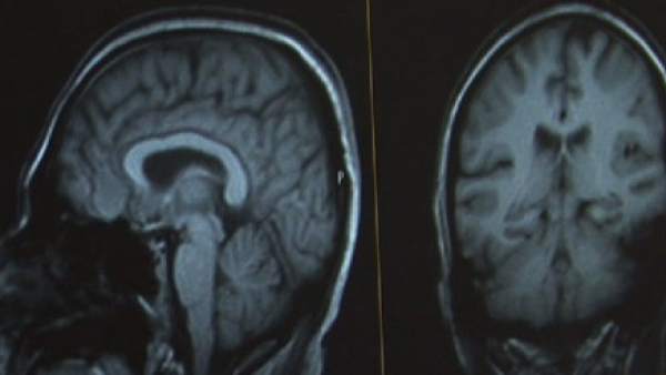 Alzheimer Alzheimer