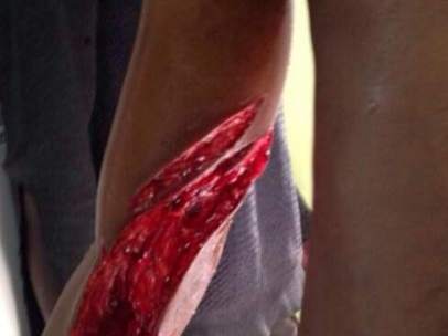 Heridas por la concertina de Melilla