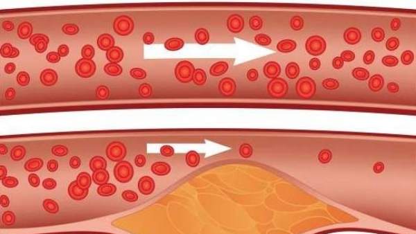 Resultado de imagen para REDUCCION DEL COLESTEROL