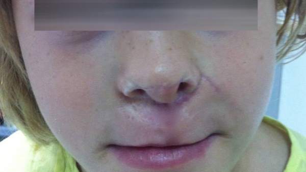 Reconstruyen la nariz de una niña a partir del cartílago y piel de su oreja Reconstruyen la nariz de una niña a partir del cartílago y piel de su oreja