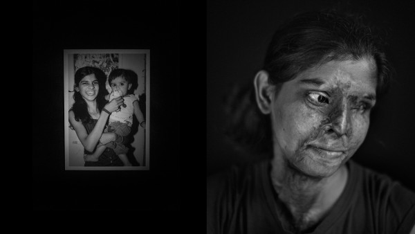 Acid Survivors in India Acid Survivors in India