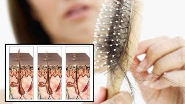Caída del cabello Caída del cabello
