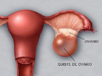 Ovarios
